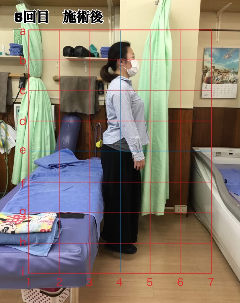 姿勢矯正コース5回目の施術後の姿勢（立位）